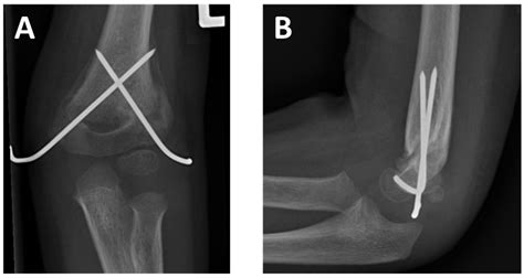 Children | Free Full-Text | Standalone Axial Malrotation after Pediatric Supracondylar Fracture ...