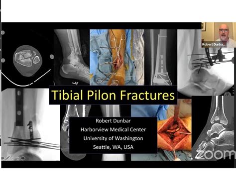 Tibial Pilon Fractures — OrthopaedicPrinciples.com