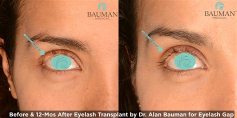 Eyelash Transplant and Implant Procedure · Bauman Medical