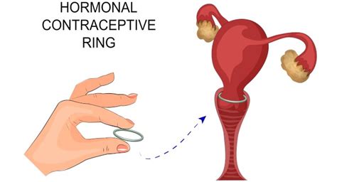 World Contraception Day 2017: Everything you wanted to know about the vaginal ring (NuvaRing ...