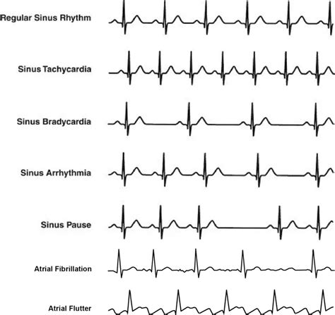 Types of arrhythmia. | Download Scientific Diagram