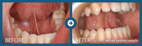 Frenectomy | Periodontal Associates of Memphis