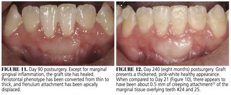 Healing Progression of the Free Gingival Graft - Decisions in Dentistry