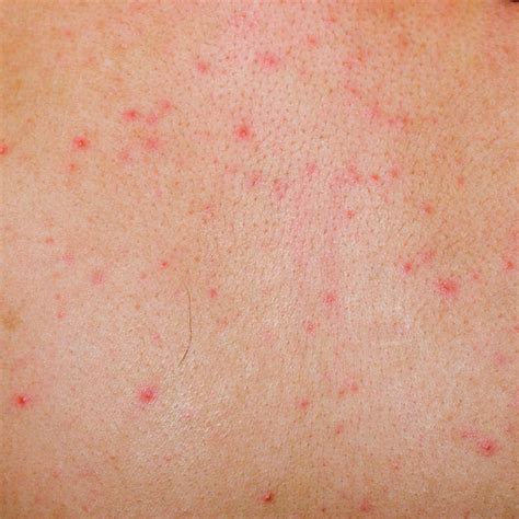 Small Red Spots On Skin Itchy Tiny Dots Bumps