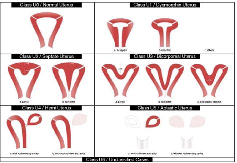 Figure 1 from Septum resection for women of reproductive age with a septate uterus. | Semantic ...