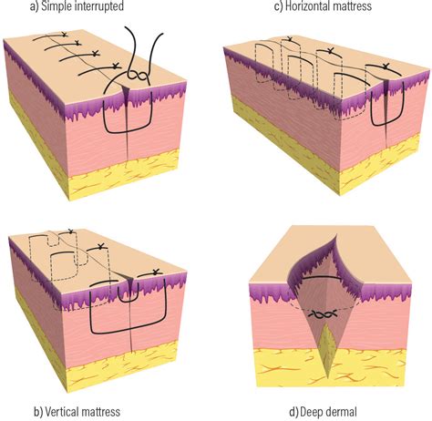 Best Mattresses of 2020 | Updated 2020 Reviews‎: Buried Vertical Mattress Suture