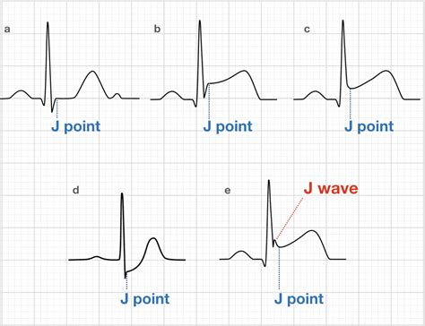 WHEN TO TELL STEMI,NSTE-ACS,LOW/INTERMEDIATE RISK ACS, BY ST SEGMENT AND T WAVE IN ECG?