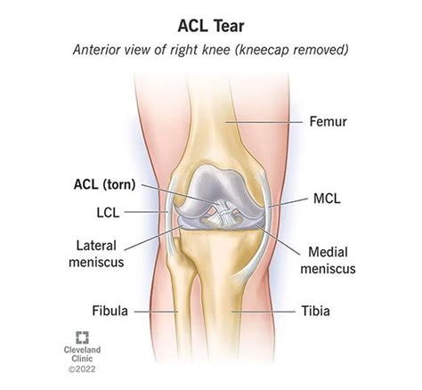 ACL Tear & Injury: Symptoms & Recovery | Acl tear, Acl, Acl knee