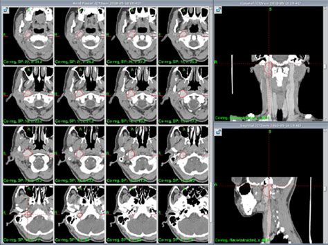 Pakistan Gamma Knife: Gamma knife Radiosurgery for Glomus Jugulare Tumor.