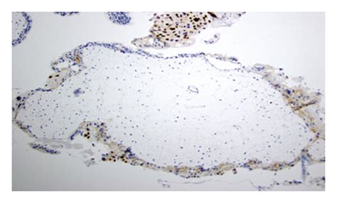 Complete hydatidiform mole slides. Histology and immunohistochemistry ...