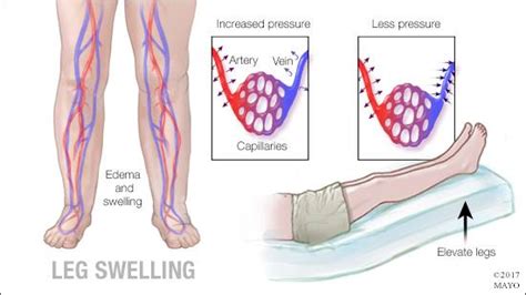 Mayo Clinic Q and A: Mild leg swelling should be evaluated - Mayo Clinic News Network