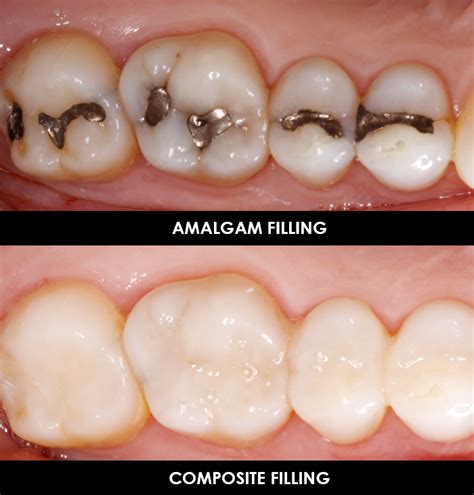 amalgam fills Archives - Santa Ana Smiles on Bristol Dentistry & Dentists