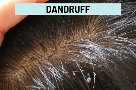 Scalp Flakes in Hair: Dandruff and 8 Other Causes