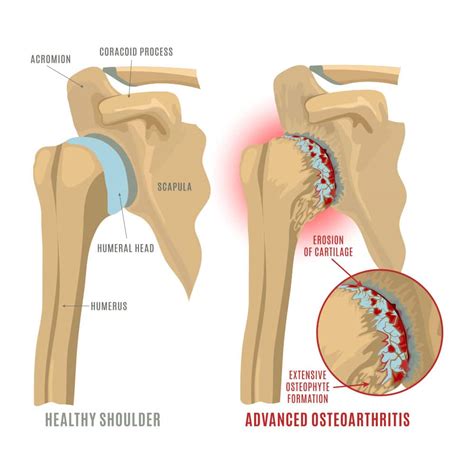 Shoulder Arthritis - Diarmuid Molony Orthopaedics