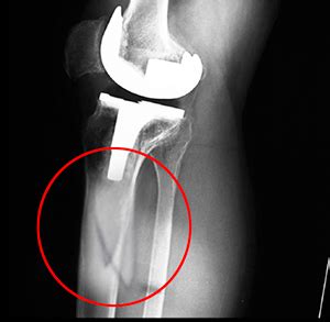 Periprosthetic Knee Fractures Jersey City | Joint-Revision Surgery Livingston, Essex County, NJ ...