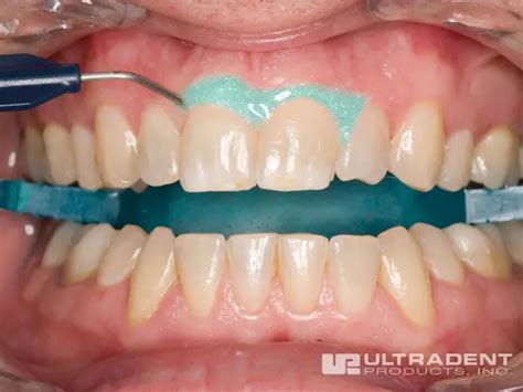 Opalescence™ Boost™ - Products - Category - Ultradent Products, Inc ...