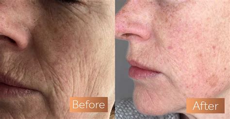 Absolute Collagen Before and After Pictures | Incredible Results