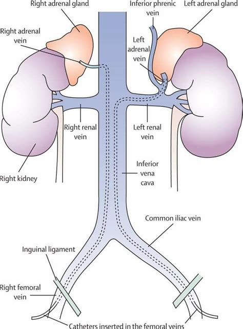 Venous sampling of adrenal glands Adrenal Glands, Adrenals, Gross ...