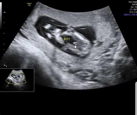 13 Week Scan Boy Or Girl Confirmed Boy In Ultrasound Gender | Images and Photos finder