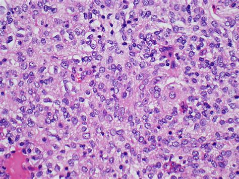 Pathology Outlines - Thymoma