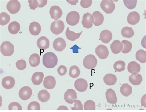 Keratocytes (Horn Cells) • The Blood Project