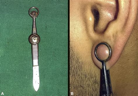 The use of chalazion clamps to create adequate sustained pressure for slit skin smear - Journal ...