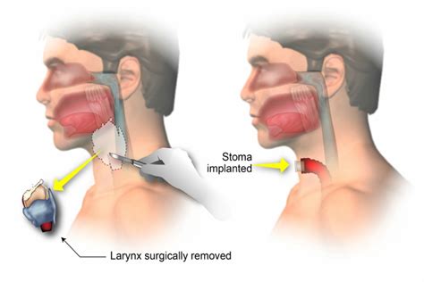 Laryngectomy Treatment & Cost Guide