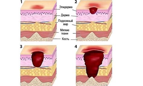 Treatment of pressure ulcers on the coccyx: methods of traditional ...