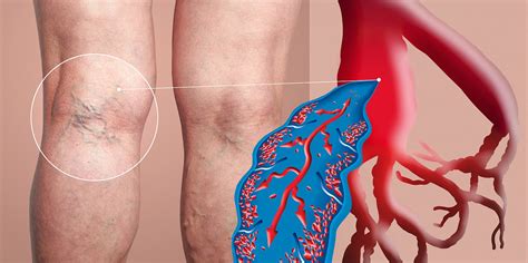 How to Know if You Have Deep Vein Thrombosis (DVT) - Beaumont Emergency Hospital