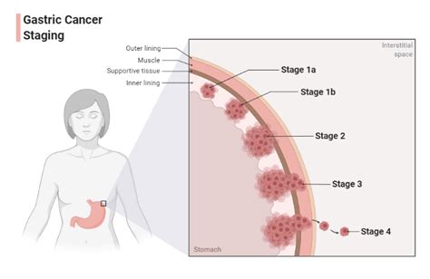 Gastric Cancer Staging | BioRender Science Templates