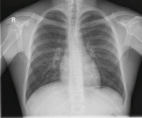 Neat How To Report Normal Chest X Ray Write A Good Introduction For Research