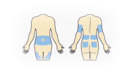 Infusion set Locations - Insertion Site Management | Medtronic