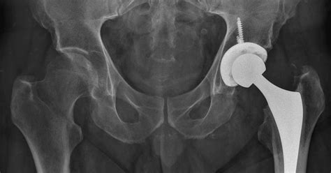 Total Hip Arthroplasty (Replacement)