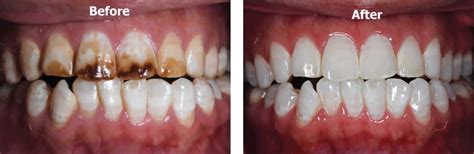 Dental fluorosis causes, prevention, symptoms & dental fluorosis treatment