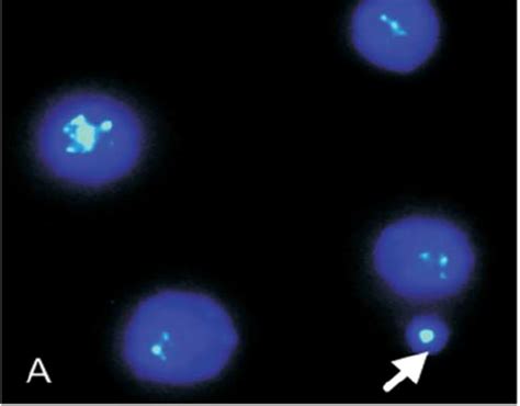 Showing chromosome 1 FISH on blastomeres ( A ) indicating 3 signals ...