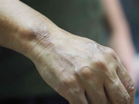 Leprosy: Signs and Symptoms