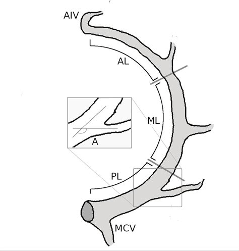 Schematic diagram of the anatomy of the coronary sinus and its ...