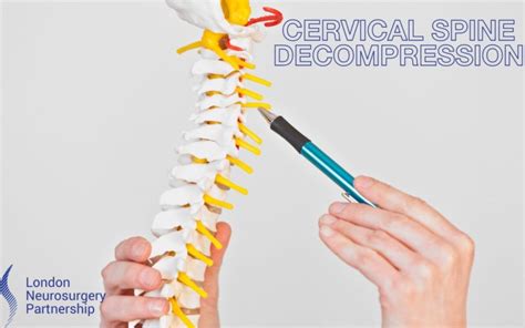 Cervical spine decompression - London Neurosurgery Partnership