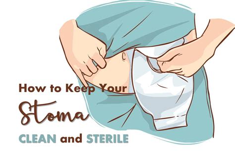 Taking Care of Your Stoma After an Ostomy | Ostomy, Stoma, Ostomy care