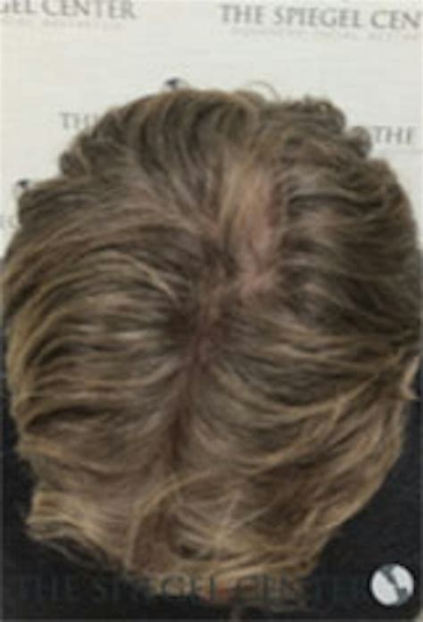 Hair Restoration | The Spiegel Center