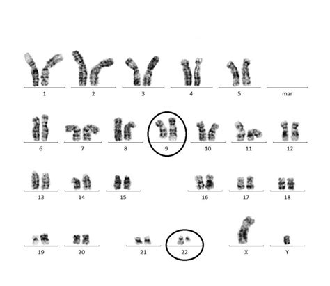 Philadelphia Chromosome by karyotype