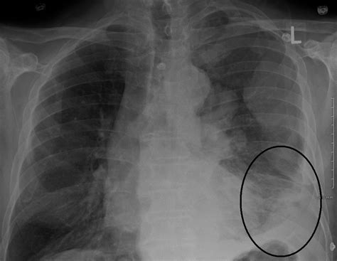 Abogado de Mesotelioma en Dallas | Abogado de Texas