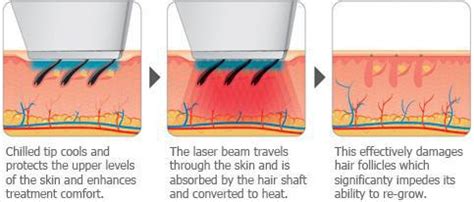 Laser Hair Removal | Wisconsin Laser Center