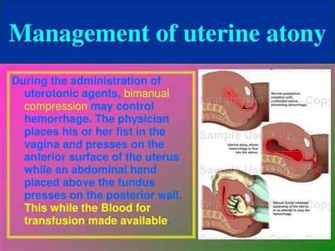 PPT - Postpartum Complications PowerPoint Presentation - ID:5438820