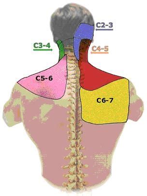 Cervical Facet Joint Syndrome | e-algos