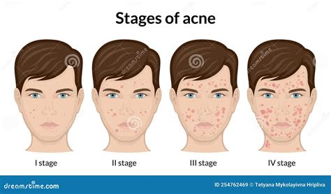 Stages of acne stock vector. Illustration of acne, phase - 254762469