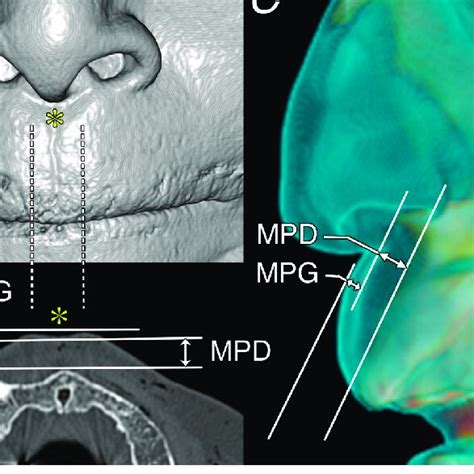 Anatomy and imaging of the nasal philtrum region in the anterior view ...