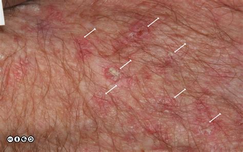 Premalignant lesions - Skin Cancer 909