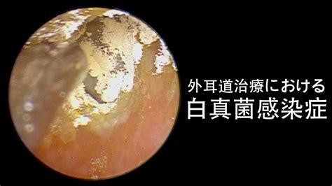 White Fungus Infection in Ear Canal Treatment - YouTube