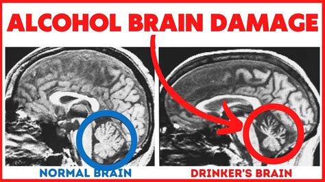 11 Ways Alcohol Induces Brain Damage - Often Irreversible! - Alcohol Mastery